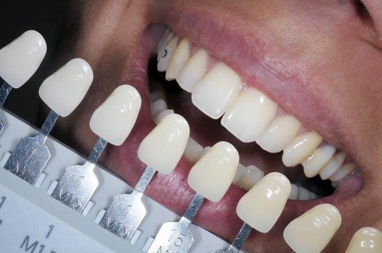Blanchiment des dents couleur-dent-beaute-dentiste