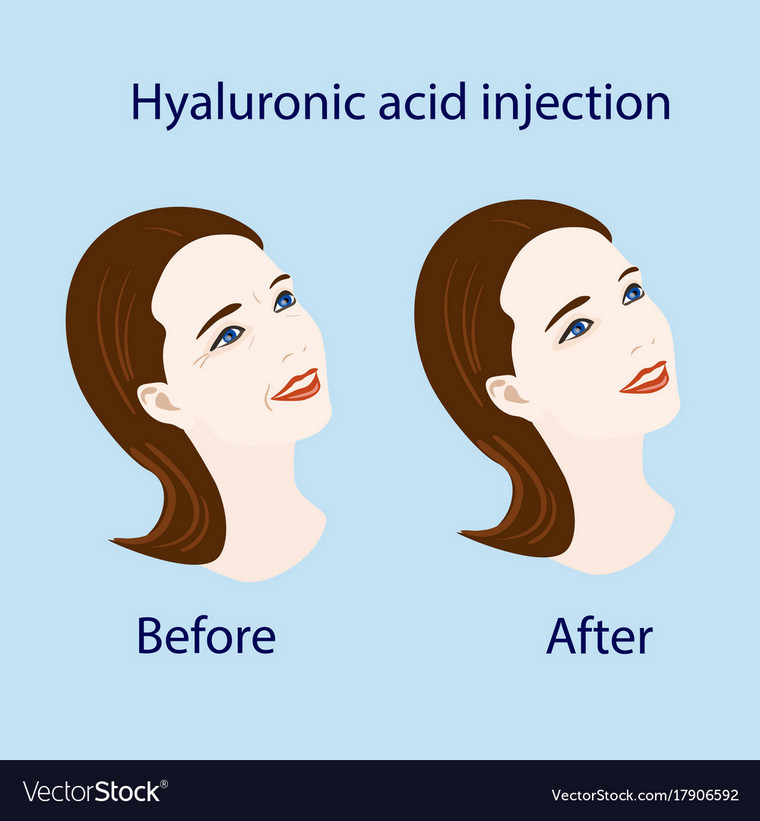 acide hyaluronique avant apres
