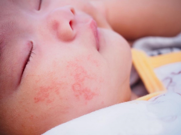 allergies médicamenteuses des bébés-l'eczéma