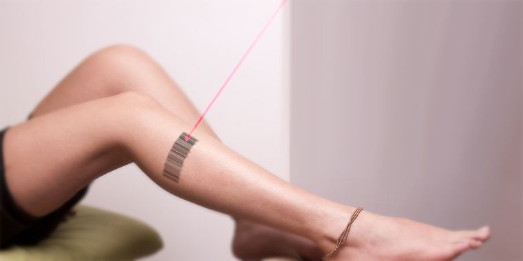 effacement de tatouage au laser avis