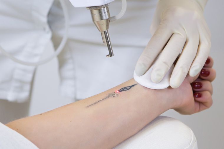 enlever un tatouage laser effacement de tatouages