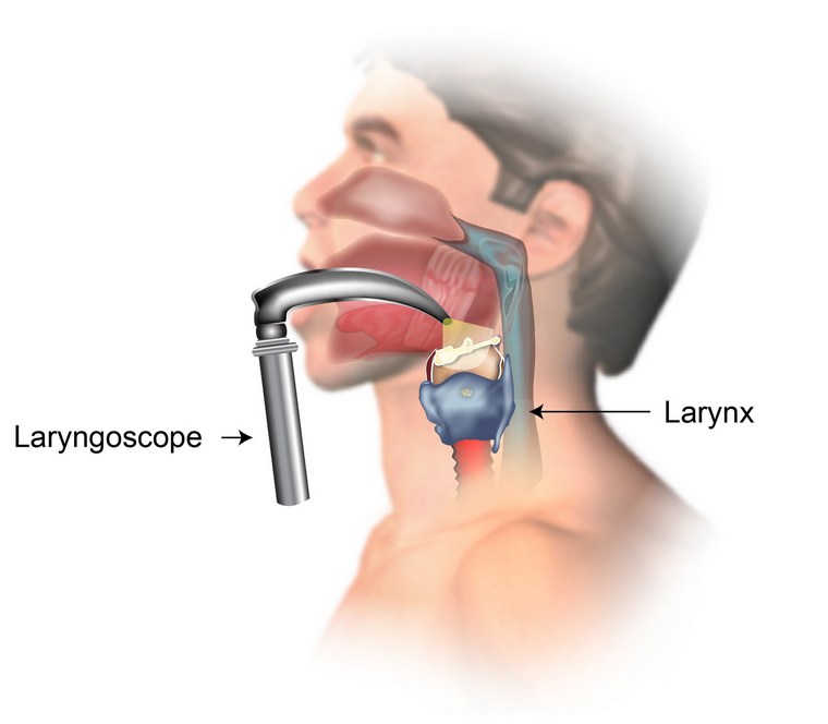 laryngoscopie gorge maux traiter