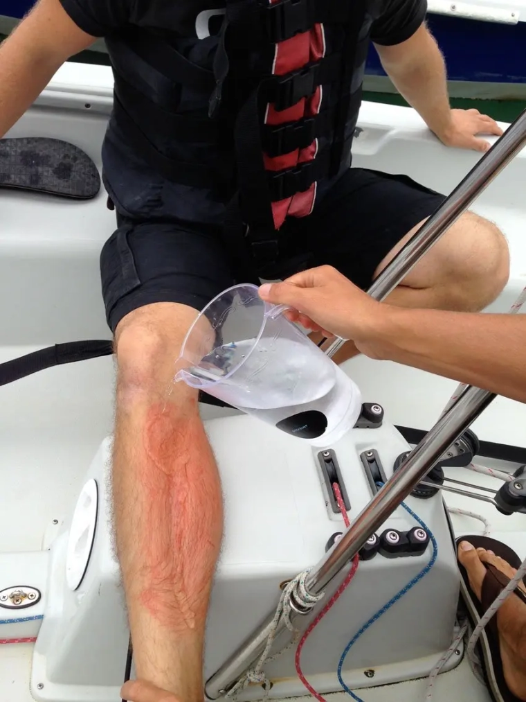 Comment traiter une piqûre de méduse